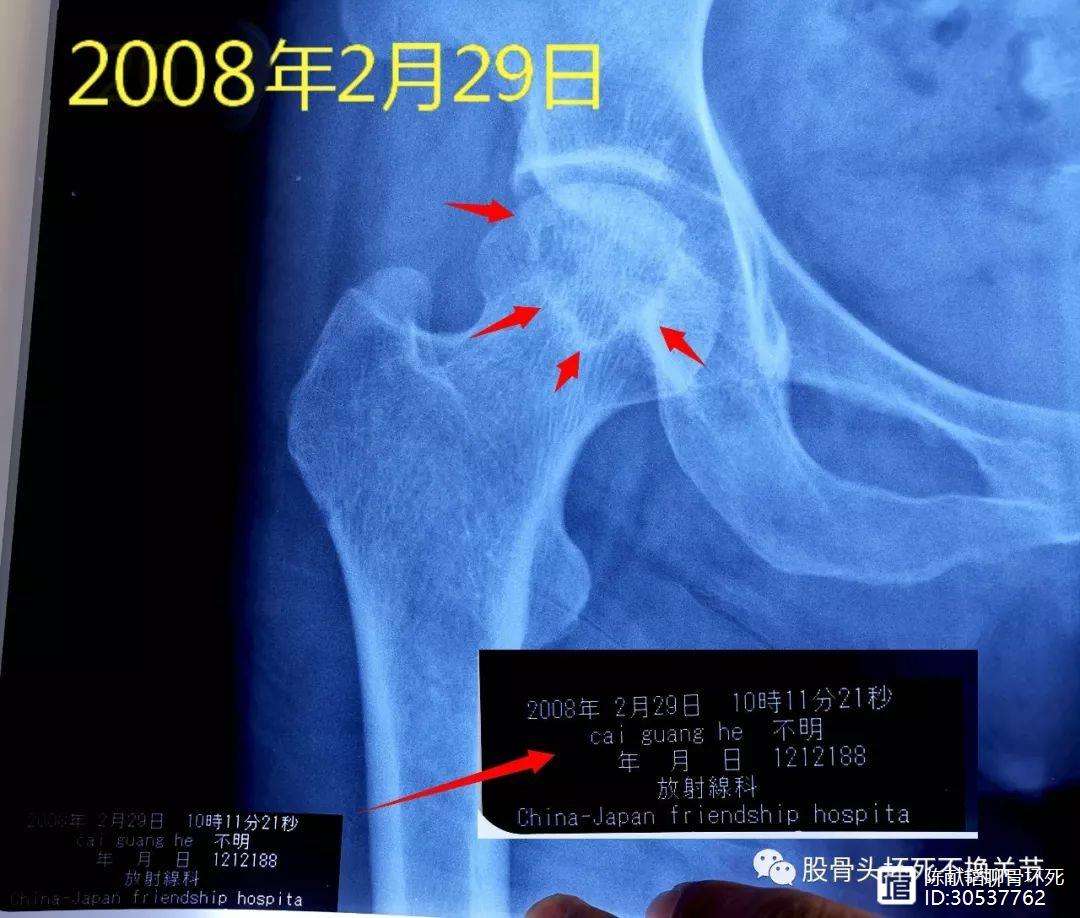 柳州人工骨头医保报销多少(人工骨头医保报销多少比例)